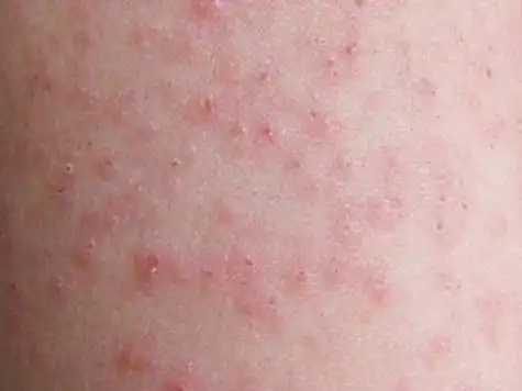 艾滋病症状图片大全