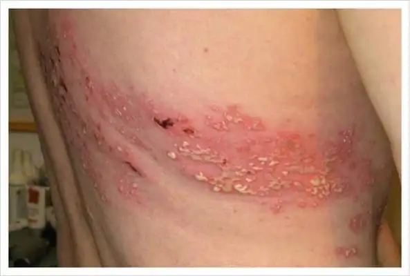 蛇盘疮图片 (28)