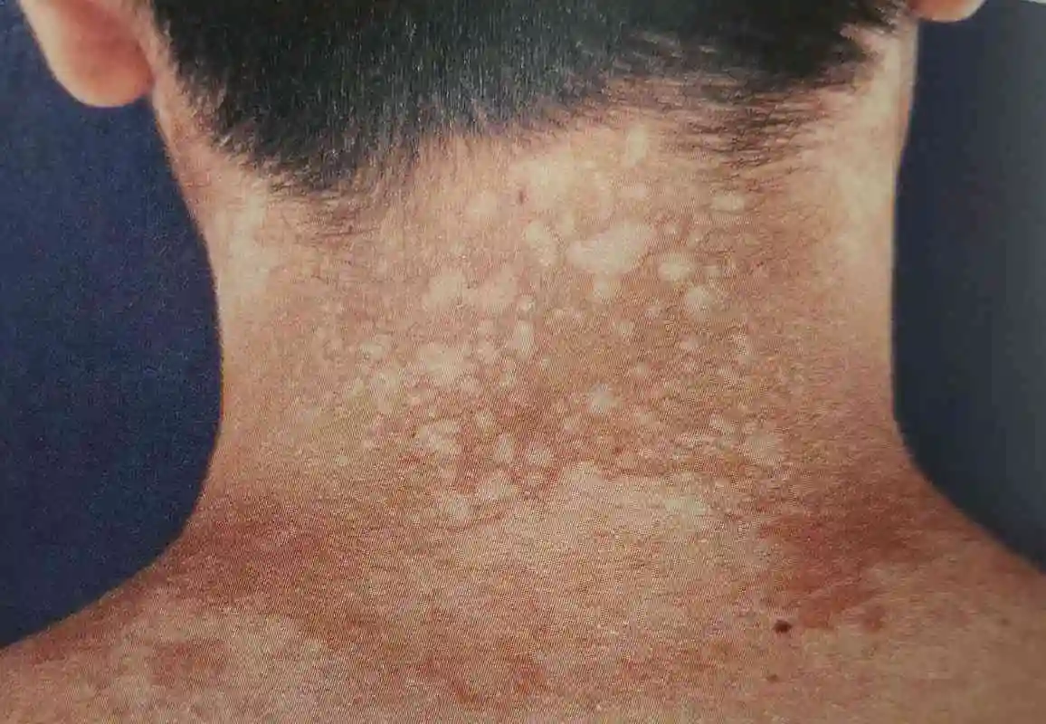 花斑癣症状_病因_治疗方法_鉴别_专家咨询|丁香医生