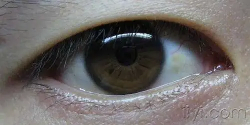 我的白眼球上有黄斑还有一点变色了