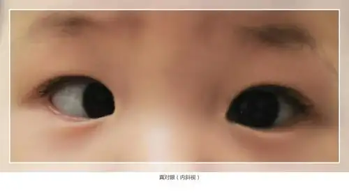 "斗鸡眼"还有真假? 如何区分