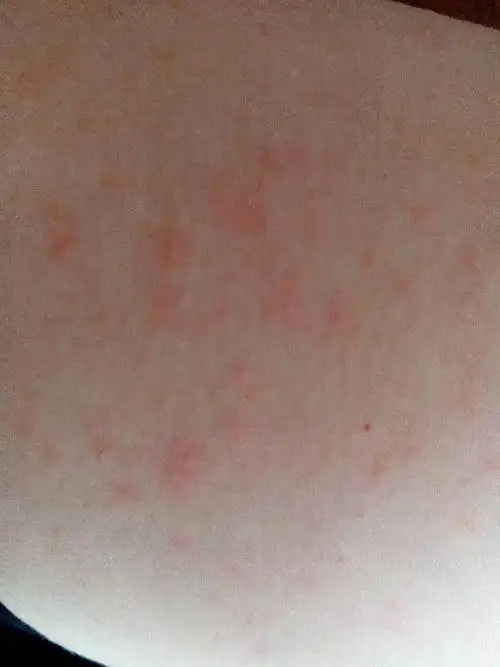 身上起这些小红点是什么情况,怎么办?有点痒,胳膊腿上都有,是过敏