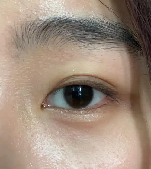 求助一只眼睛内眦赘皮严重怎么办