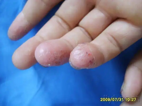 连续性肢端皮炎