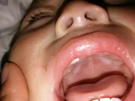 急  急  急    宝宝大牙内侧又冒出个牙尖 这