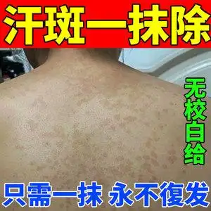 汗斑专用药治疗胸前腋下后背白斑花斑褐斑皮肤外用止痒药
