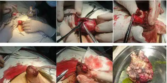 23岁女子一月不换内裤,致外阴癌癌前病变!