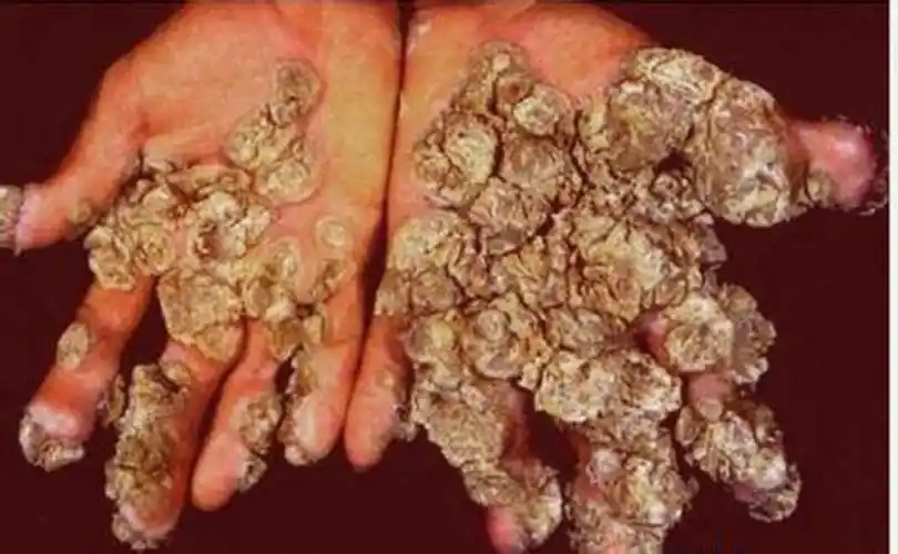 青海疣医院_青海治疗疣哪家医院好_青海治疗疣最好的医院/排行_有来