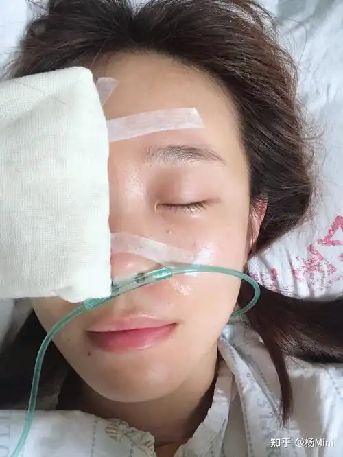 斜视手术经验分享—已痊愈,无复发!