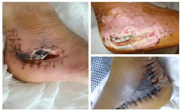 【九院技术】小切口大文章 跗骨窦小切口治疗跟骨骨折_传统_患者_畸形