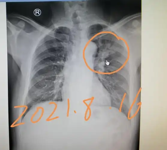 刘懿博士说肺癌(三七〇四)胸片发现问题没重视,肺癌耽误了八个月