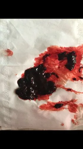 请问这个是孕囊吗?