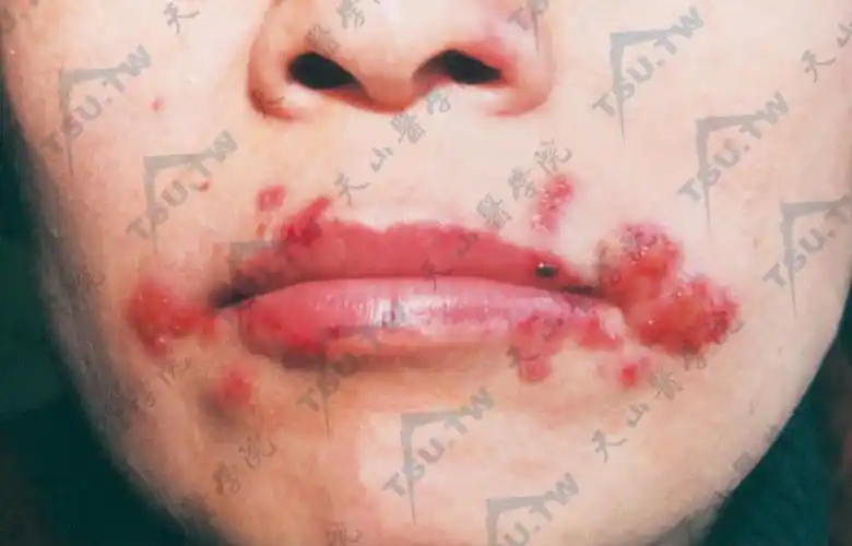 单纯疱疹病因机制症状表现诊断治疗指南