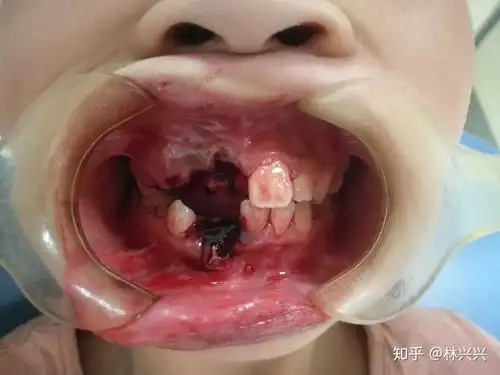 孩子门牙摔掉了,及时治疗还能保住,初见效果就不顾