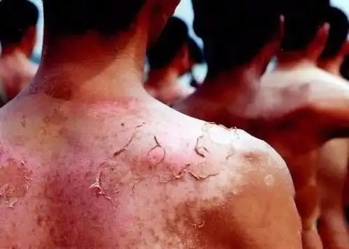 真正的中国军人:训练晒破皮,也不吭声!