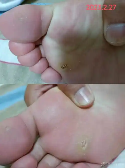 维a酸对顽固性跖疣的治疗