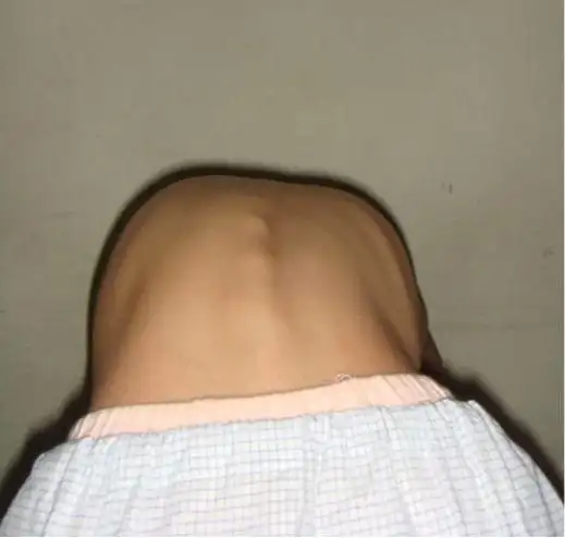 一招教你发现孩子脊柱有无侧弯|畸形|椎体|肋骨|姿势性_网易订阅