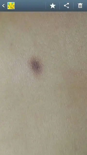 问:我皮肤上长的这两个黑斑是什么啊?不痛不痒的,不是伤口好后结的疤