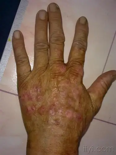 手背部皮疹十余年