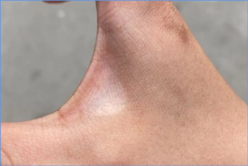 早期白癞风是小白点吗/怎么预防进展