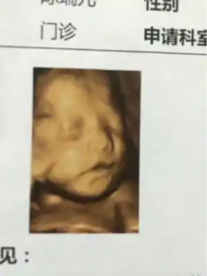 请各位宝妈帮我看一下这个四维是兔唇吗?