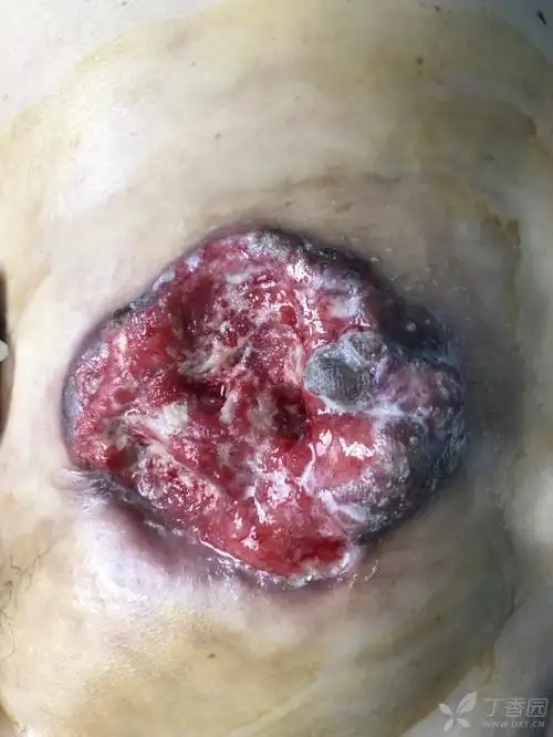 乳腺癌,火山样破溃,过目难忘!