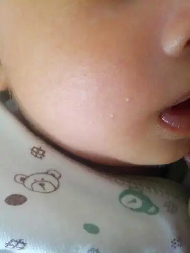 宝宝脸上这个像脂肪粒样的东西长了都快一个月了,宝宝现在是39天了