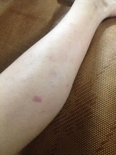 我的小腿被一种东西咬了,现在整个小腿肚子都是奇痒,而且痒的范围在