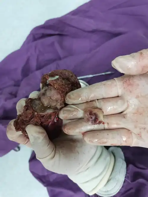 对于其他的良性肿瘤,像腺瘤对于肝脏病变,目前体检发现的越来越多