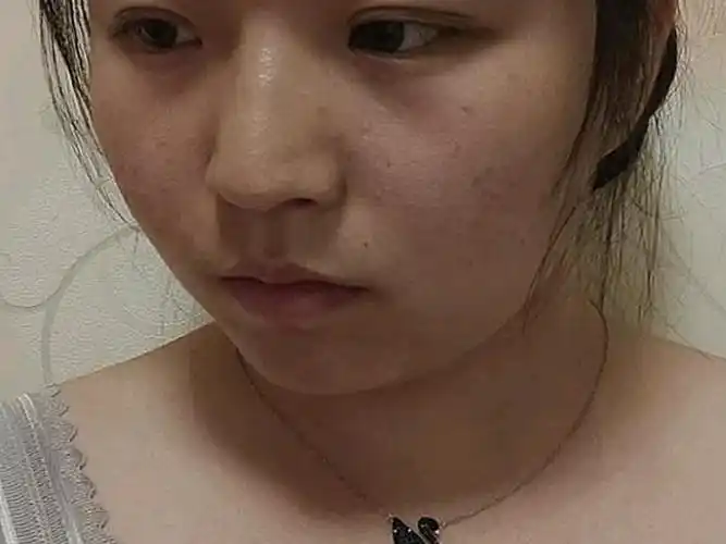 热玛吉真的很有效果脸部的紧绷是从真皮层感觉出来的就是感觉皮肤里面