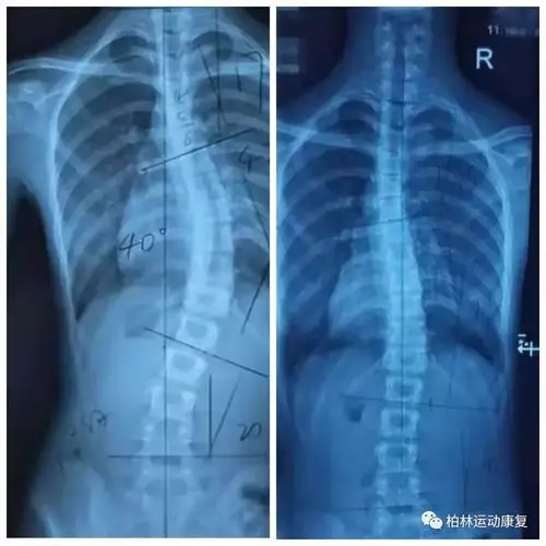 青少年体态康复脊柱侧弯全面解读与运动康复