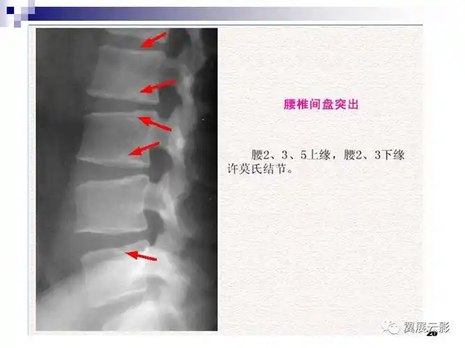 腰椎间盘突出的影像诊断