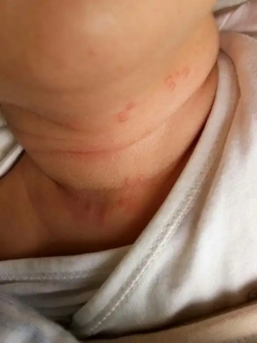 请问这是痱子,还是湿疹,该怎么办?_百度知道