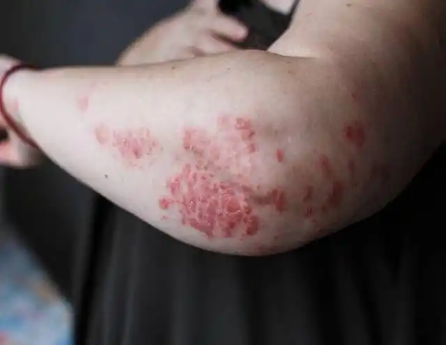 不痛不痒为何会得皮肤癌提醒早期4个迹象奈何你却没发现