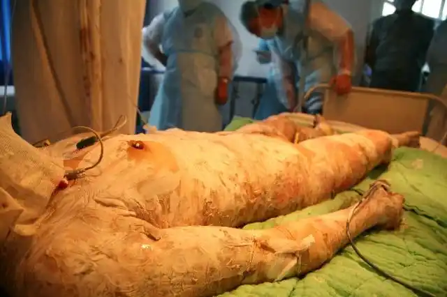 烧伤病人均平稳