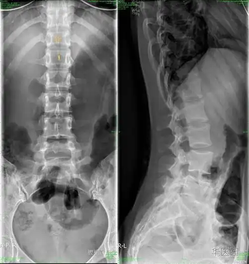 腰椎隐裂