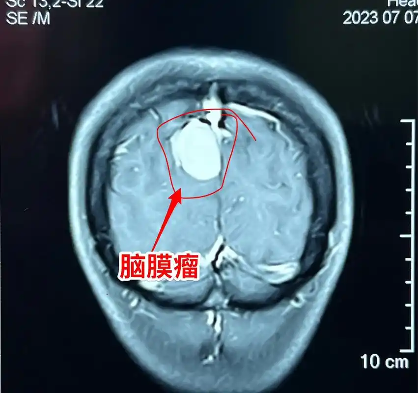 脑膜瘤通常是良性肿瘤,个别脑膜瘤是恶性的.