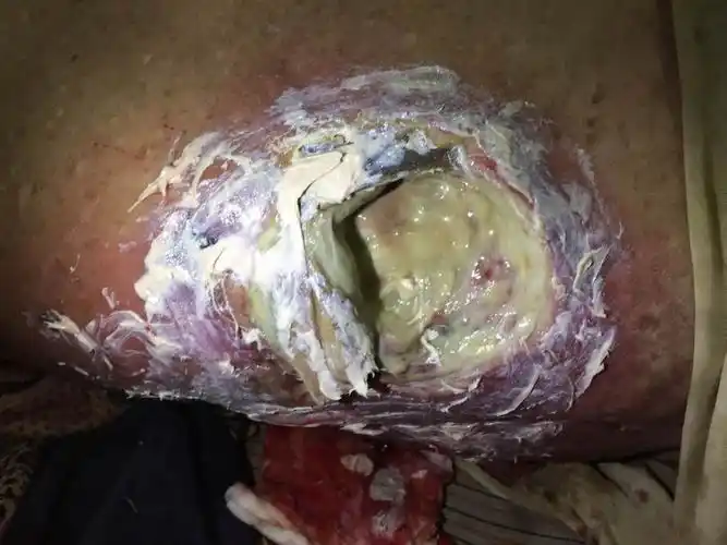 家里老人80多岁了褥疮求治病方法很严重找医生都不来.