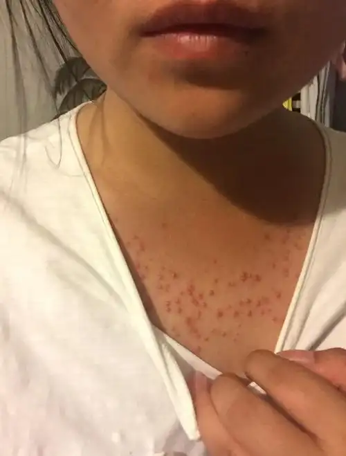 请问下我胸前长的这是什么痘痘,好恶心啊!