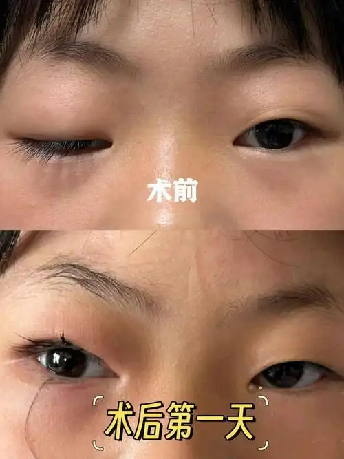 太原市人民医院:矫正上睑下垂,点亮"睛"彩人生|手术|眼睑|畸形|结膜