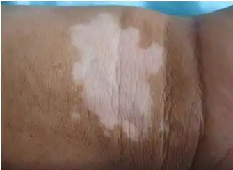 出现的地方,如果得了白癜风,一定要及时治疗,才能早日恢复正常的皮肤