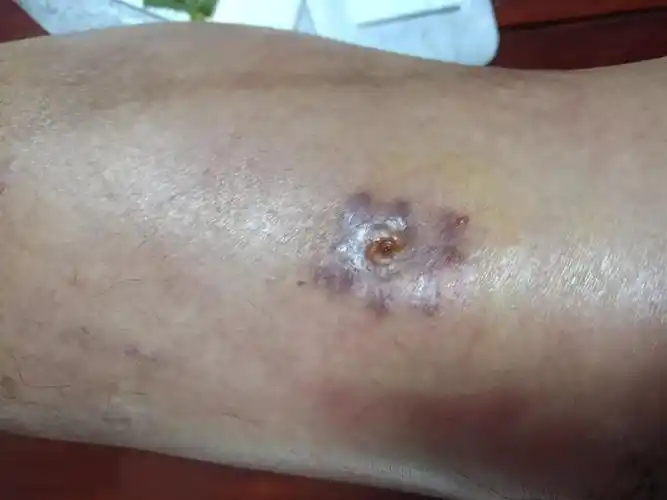 中医药在外科术后感染中的应用 写美篇12月24日 另一钢钉手术伤口也