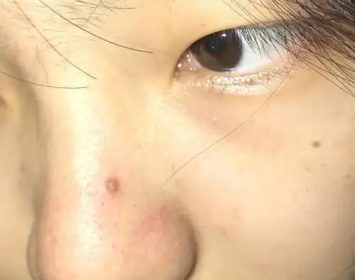 为什么取出来是个黄色小粒!黑头都是这样的吗!但是好大一个洞咋办!