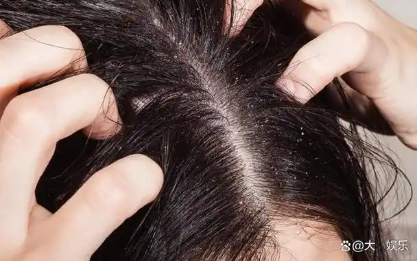 螨虫最大"天敌"原来不是暴晒?教你个笨办法,螨虫"跑光了"