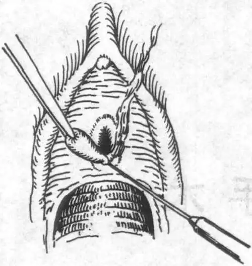 尿道肉阜是尿道口黏膜下组织受炎性刺激增生形成的良性息肉状赘生物
