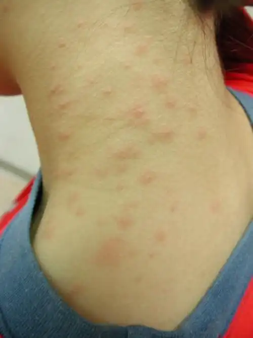 脸部皮肤过敏症状图片