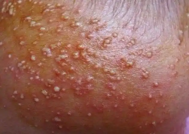 宝宝胸前这个是热疹吗宝宝湿疹热疹痱子如何分辨71新生儿如何护理