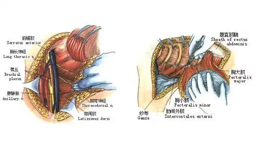根治性乳房切除手术-手术图解