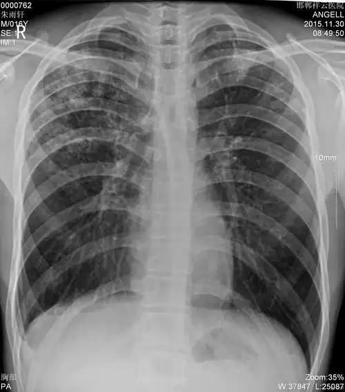 咳嗽一周不发热胸片能否诊断大叶性肺炎