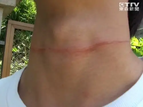 风筝断线勒骑士,男大生颈留20cm瘀痕.